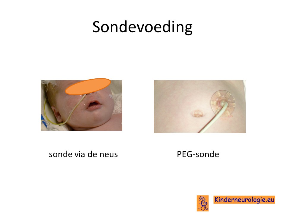 sondevoeding